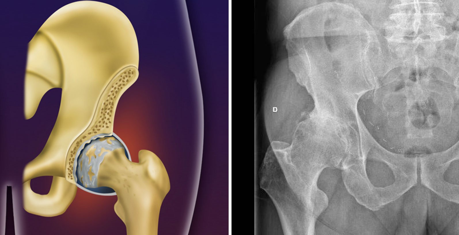 Artrose avançada no quadril | Dr. Felipe Bessa