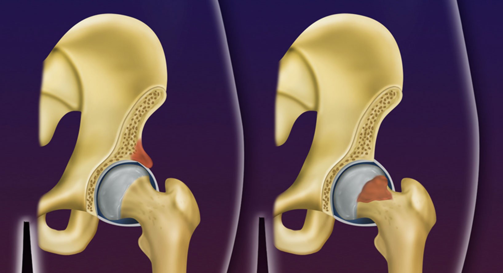 Impacto femoro-acetabular | Dr. Felipe Bessa