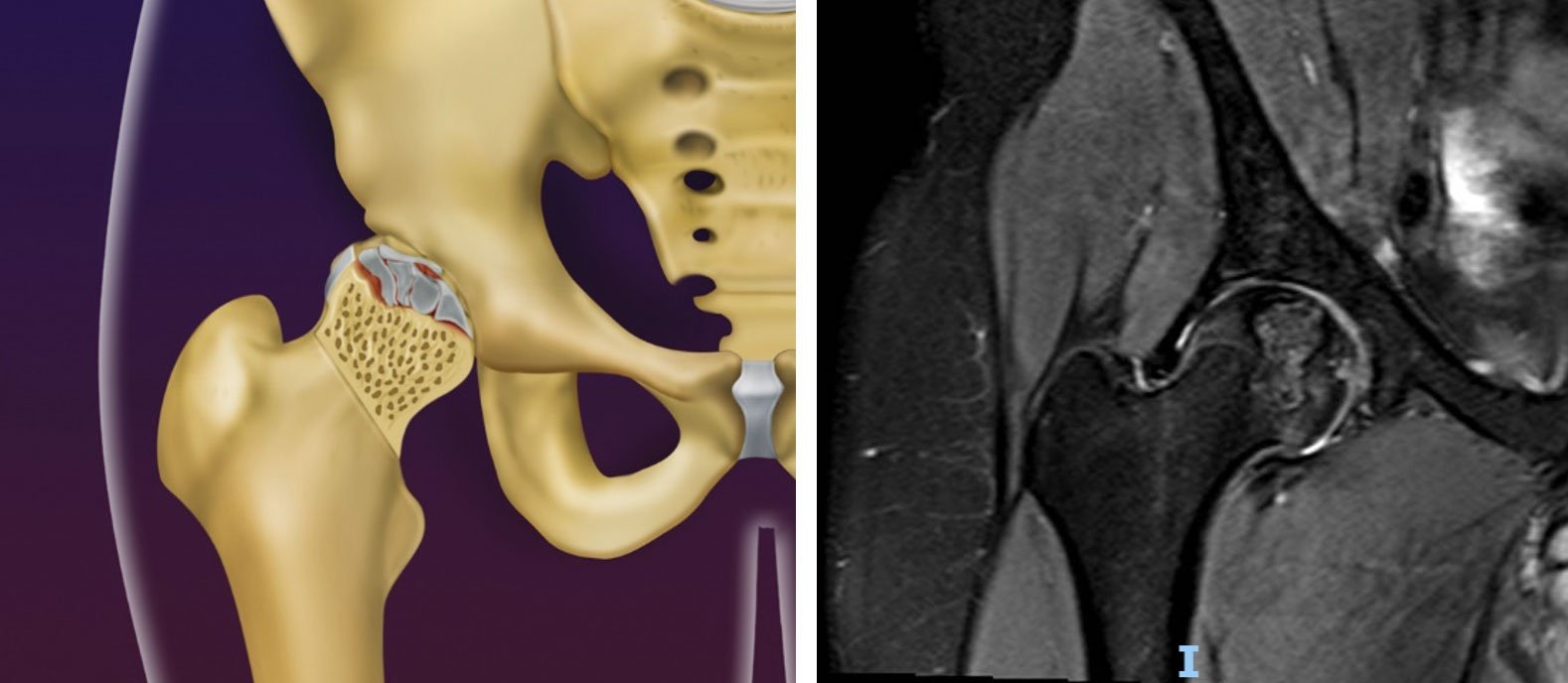 Osteonecrose da cabeça do fêmur | Dr. Felipe Bessa