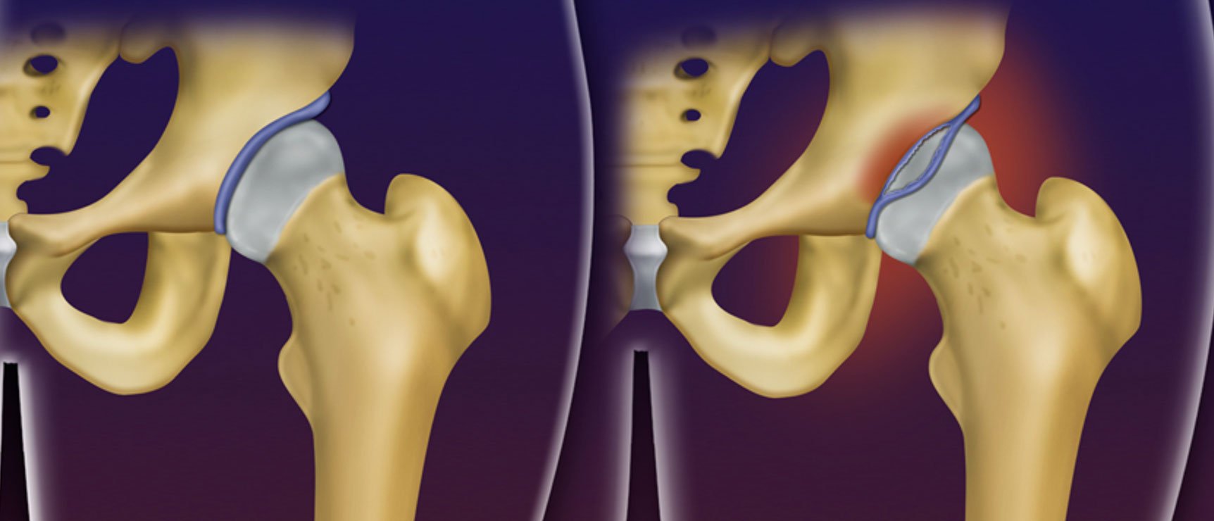 Lábio acetabular com um destacamento/rotura | Dr. Felipe Bessa