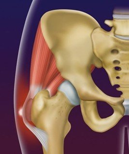 Tendinopatia e peritendinite insercional do glúteo médio e mínimo
