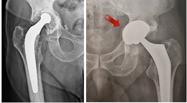 Radiografias mostrando solturas da prótese de quadril.