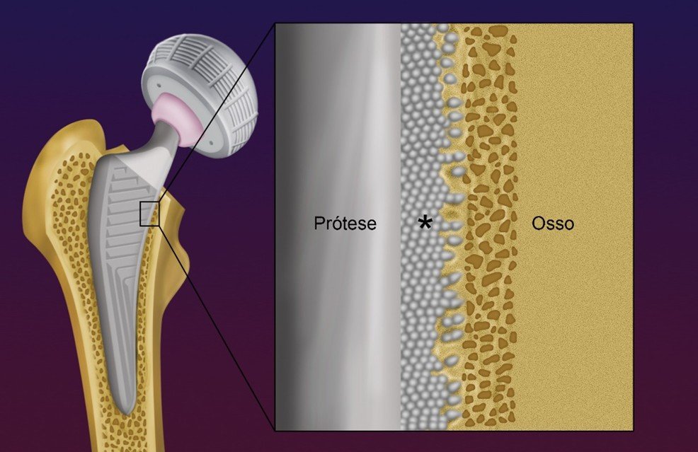 Imagem ilustrando o processo de osteointegração, no qual o osso do paciente adentra os microporos que revestem a prótese.