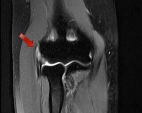 Imagem de Ressonância Magnética do cotovelo, apontando tendões extensores inflamados e degenerados, típico da epicondilite lateral.
